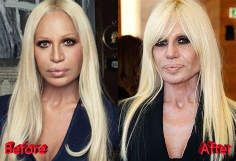 donatella versace died|donatella versace before and after.